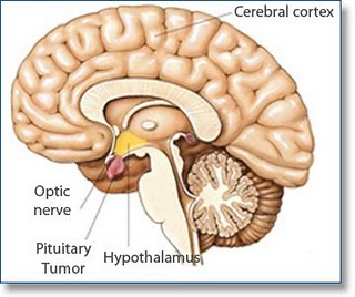 pituitary tumour